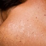 So wird die Haut schnell wieder schön - das hilft bei Sonnenbrand