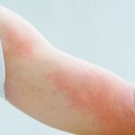 Keine Allergien bitte - Wie hautverträglich sind Wärmepflaster?